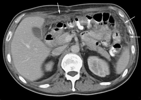 Gastric Cancer In A 53 Year Old Woman Ct Image Demonstrates Diffuse