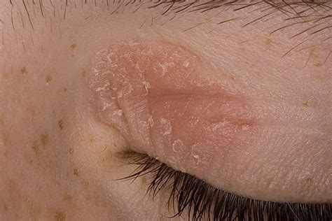Eczema Picture Hardin Md Super Site Sample
