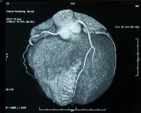 Coronary Ct Scan Cost Cardiac Ct Scan Computed Tomography