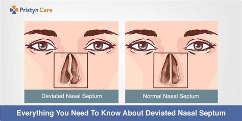Everything You Need To Know About Deviated Nasal Septum Pristyn Care