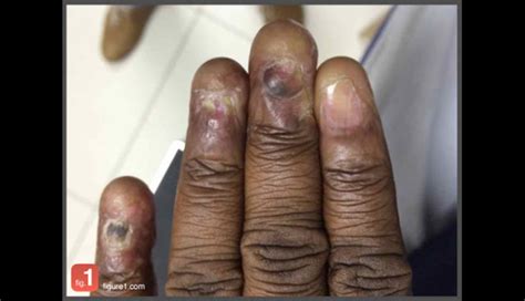 Image Of The Week A Rare Dermatologic Finding Clinical Advisor