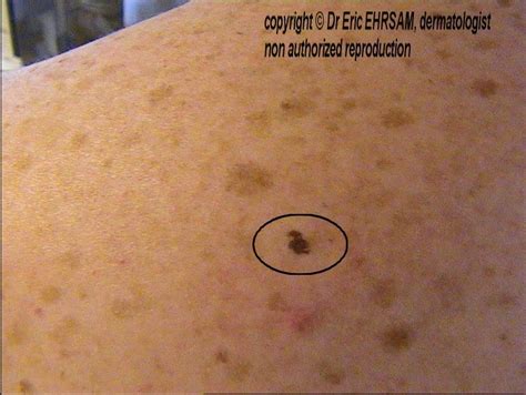 Dermoscopy Ink Spot Lentigo