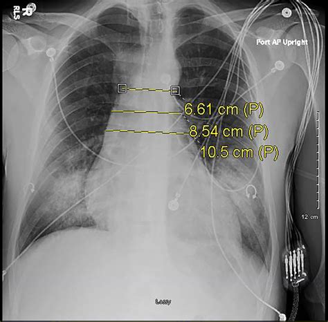 Aortic Dissection On Chest X Ray