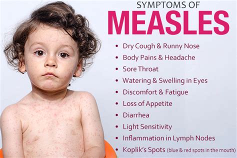 Measles Virus Treatment Mskhealthspot