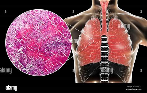 Tuberculose Goticulas Ou Aerossois