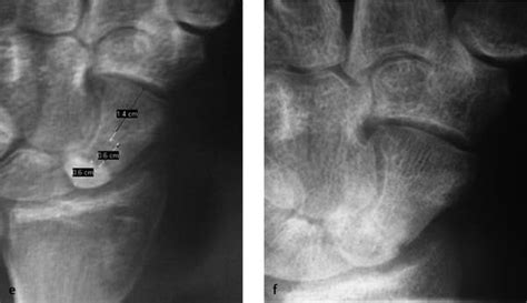 Scaphoid Proximal Pole Fractures Musculoskeletal Key