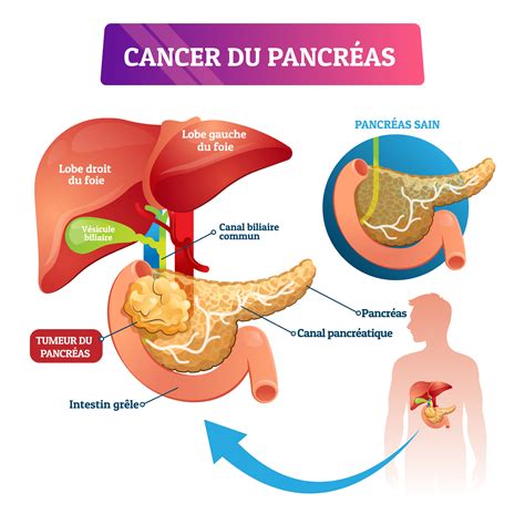 Analyse De Sang Et Cancer Du Pancreas Sange Blog My XXX Hot Girl