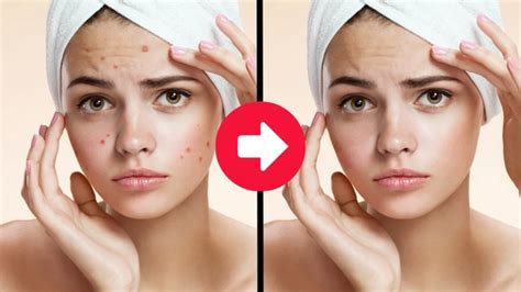 Как убрать дефекты кожи в фотошопе Устраняем недостатки кожи в Фотошоп