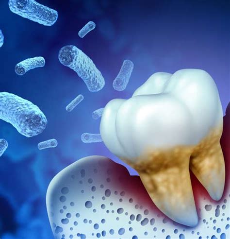Zahnfleischentzündung behandeln Ursachen Symptome Hausmittel