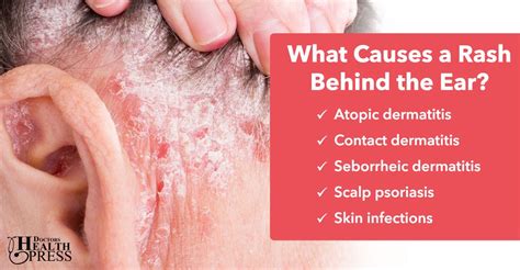 Rash Behind The Ear 5 Causes And Treatments Seborrheic Dermatitis