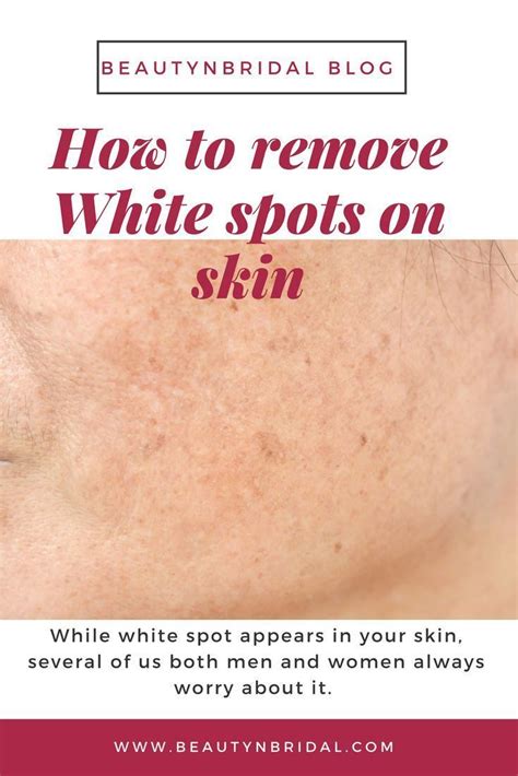 White Spots On Skin Remove Simple Home Remedies Skin Spots White