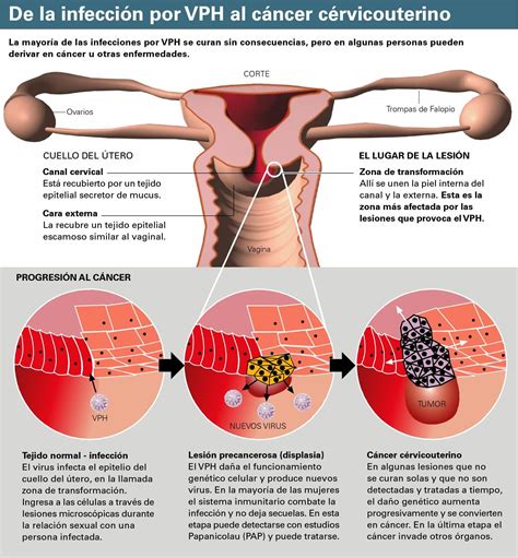 Lista Foto Im Genes Del Papiloma Humano En Mujeres Actualizar