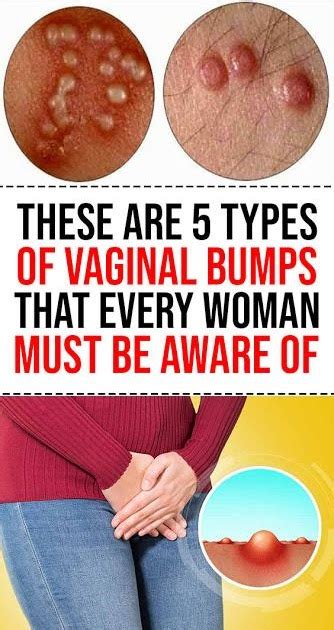 What Are The Different Types Of Vaginal Bumps That Every Woman Should