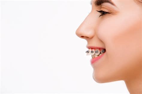 Understanding And Addressing Overjet Teeth Insights And Solutions
