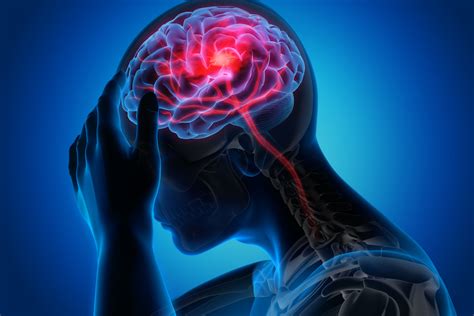 Stroke Signs Symptoms Causes And Treatments
