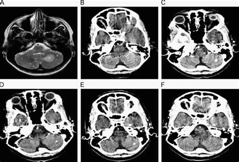 Magnetic Resonance Imaging Mri And Computed Tomography Ct Scans
