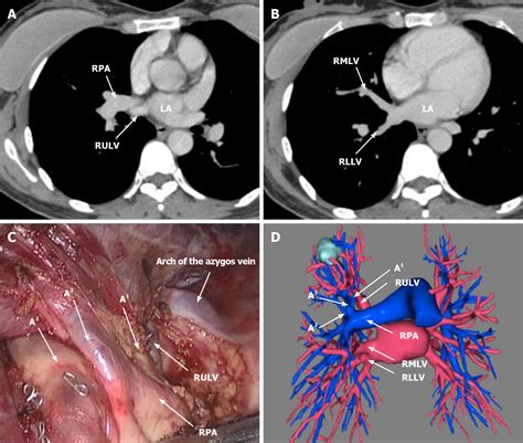 Rare Location And Drainage Pattern Of Right Pulmonary Veins And