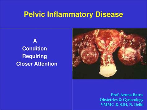PPT Pelvic Inflammatory Disease PowerPoint Presentation Free Download ID