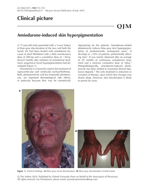 Pdf Amiodarone Induced Skin Hyperpigmentation