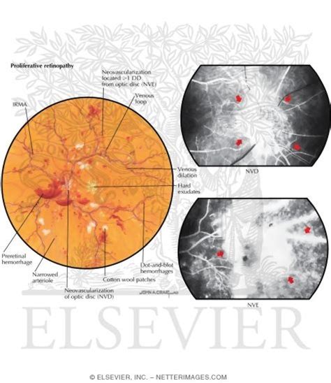 Diabetic Retinopathy