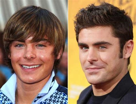 Zac Efron Plastic Surgery Nose Job The Curious Case Of His Rhinoplasty
