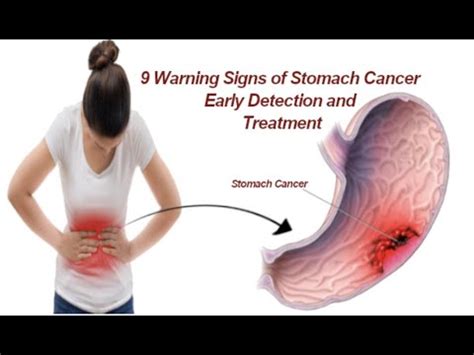 9 znakov in simptomov ki lahko kažejo na raka želodca Fitnes 2022