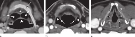 Normal Laryngeal Anatomy Axial Images From Computed Tomography Ct