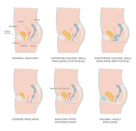 Pelvic Organ Prolapse Physio Ideas Pelvic Organ Prolapse Pelvic Hot