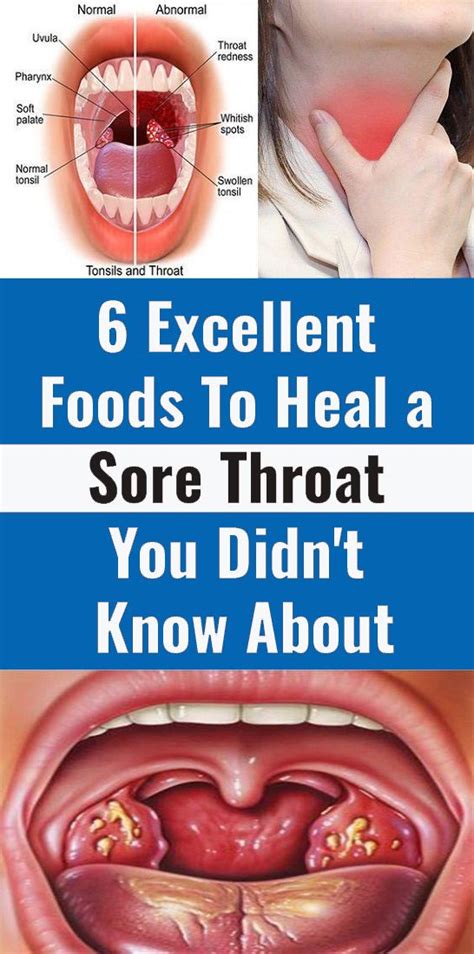 6 Foods That Can Help You Heal Sore Throat Health And Tips