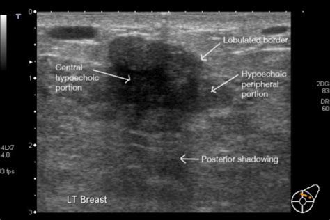 Fibroadenoma In A Lactating Breast Incorrect Thi Open I