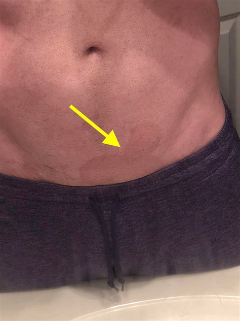Discolored skin on stomach and groin area. : medical
