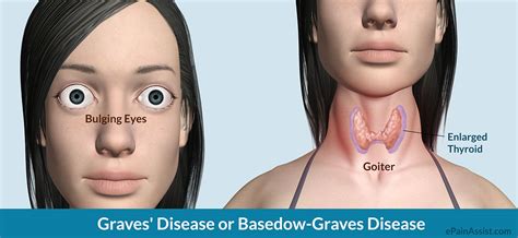 Graves Disease Or Basedow Graves Diseasecausessymptoms