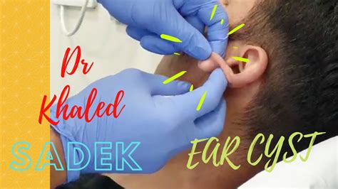 Massive 15 Yr Ear Cyst Dr Khaled Sadek Youtube