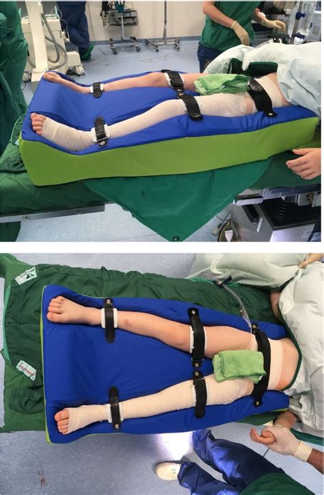 Figure 3 From Foam Splint Versus Spica Cast—early Mobilization After Hip Reconstructive Surgery