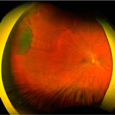 Fundus Image Of The Left Eye Showing Pars Plana Cyst Temporally From