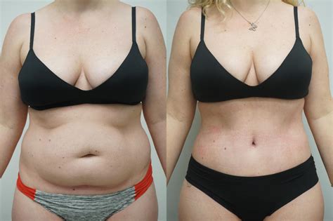 Laser Scar Removal Before And After Tummy Tuck