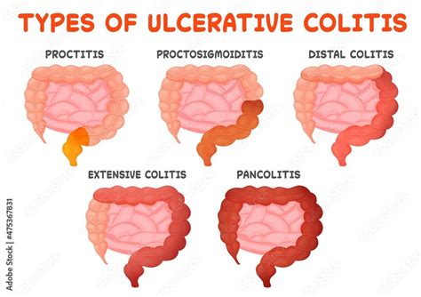 Ulcerative Colitis Types Gut Disease Intestine Inflammation From