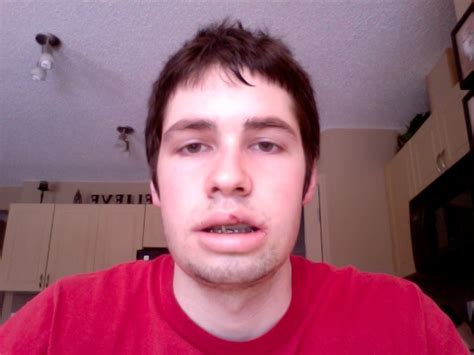 Day 3 The Peak Of The Swelling Double Jaw Surgery