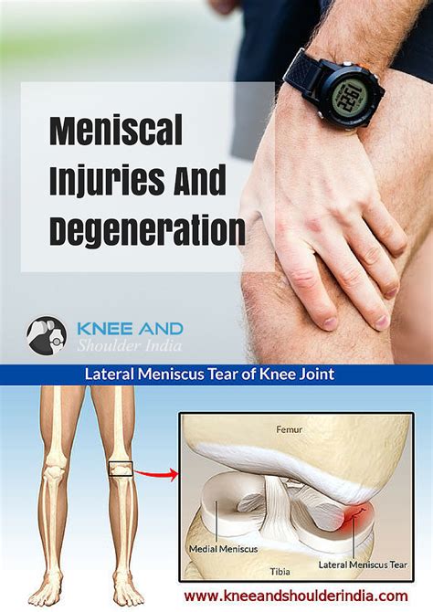 How Long Does A Knee Meniscus Tear Take To Heal Chris Mehl Kapsels