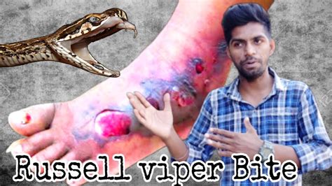 आखिर क्यूं है दुनिया का सबसे खतरनाक सांपrussell Viper Snake Bite