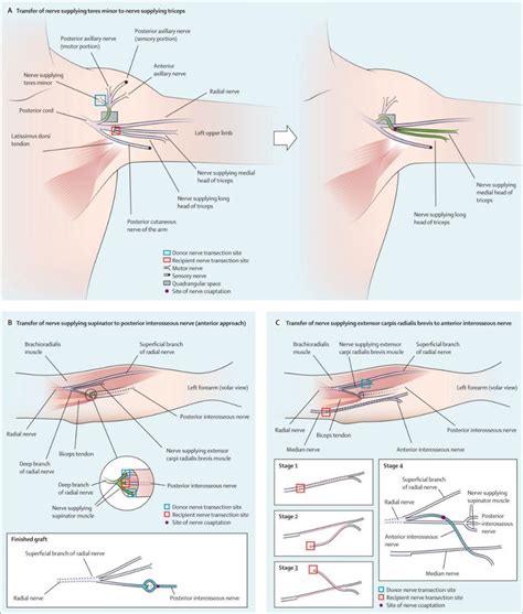 Early Nerve Transfer Surgery Is A Safe And Effective Addition To