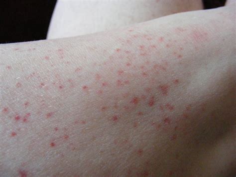 Red Splotches On Lower Legs Pictures Photos