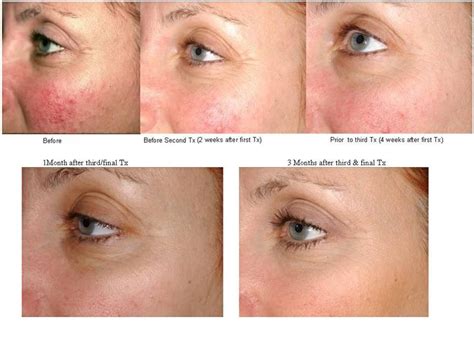 Laser Genesis Before And After Photos Rosacea Treatment Rosacea Skin