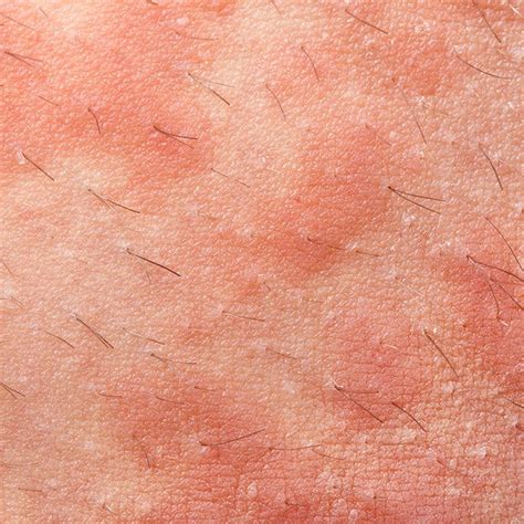 Rashes Different Types Of Rashes Diagnosis Kulturaupice