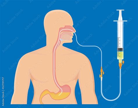 Fotomural Peg Gastric Nasojejunal Orogastric Inserted Nasoduodenal