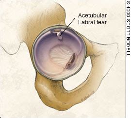 Treating Labral Tears With The Mckenzie Method Enhanced Physical Therapy