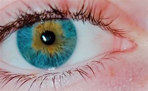 I Saw Some Say That They Have Sectoral Heterochromia And I Raise You
