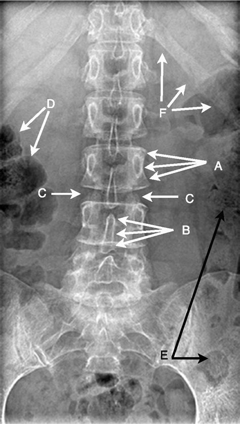 Annotated Ap Lumbar Spine Radiograph A Vertebral Body B Spinous
