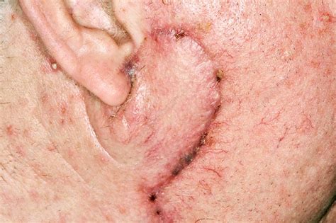 Squamous Cell Carcinoma Skin Cancer Stock Image C0370922 Science