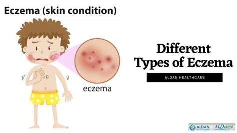 Different Types Of Eczema How To Identify Eczema Eczema Cream